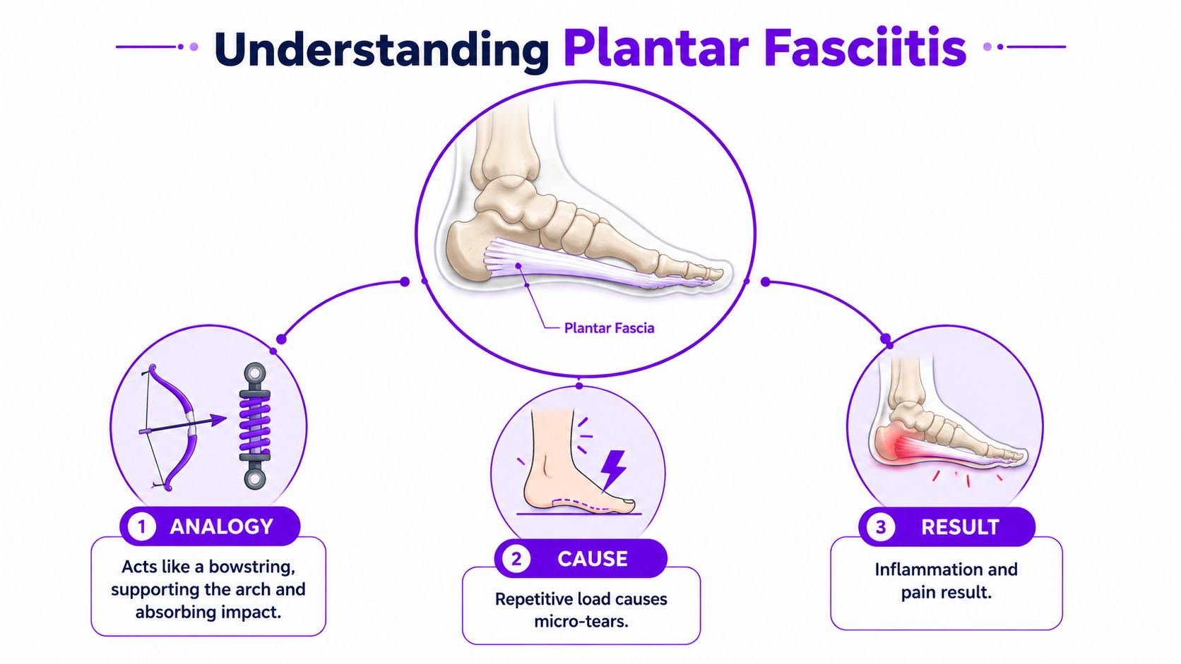 An infographic explaining plantar fasciitis showing its function, cause of micro-tears, and resulting inflammation and pain.
